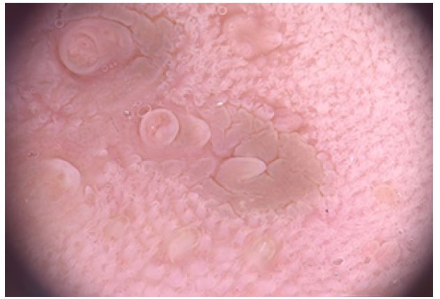 Congenital Melanotic Macule of the Tongue: A Five-Year Follow-up
