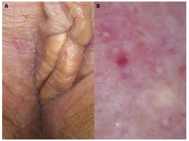 An Atypical Presentation of Extragenital Lichen Sclerosus et Atrophicus